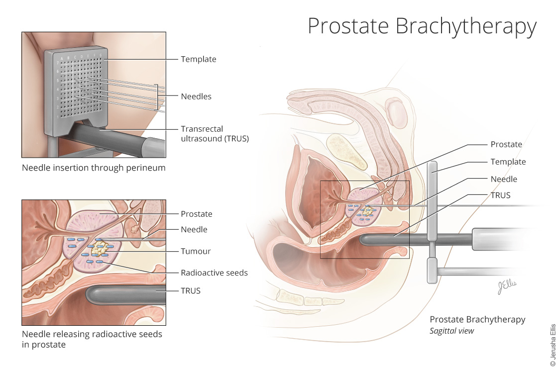 Prostate Bracytherapy